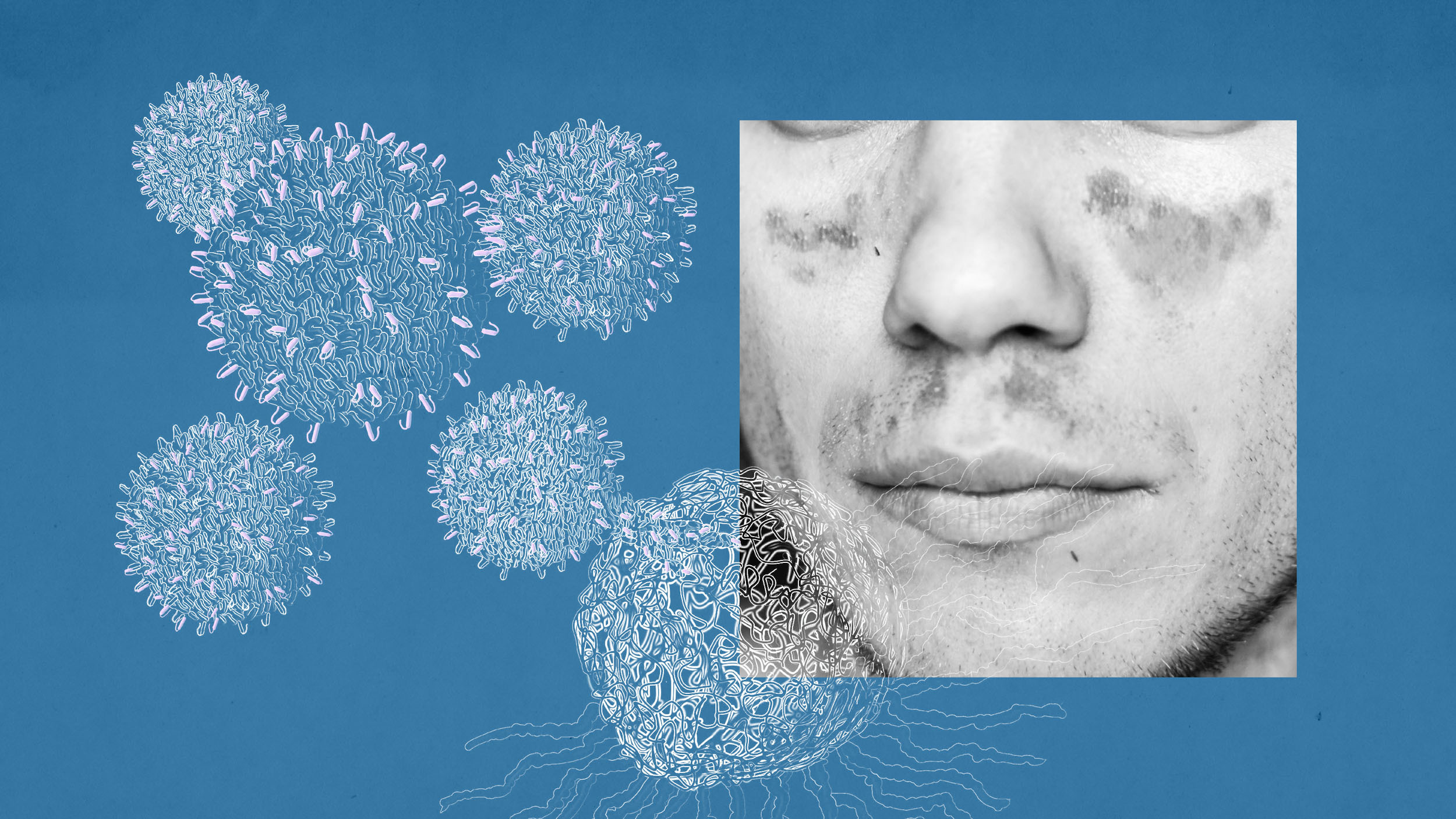 CAR-T cells on a blue background and a black-and-white photo of a man's face with characteristic lupus rash